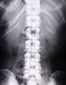 腰痛画像X線
